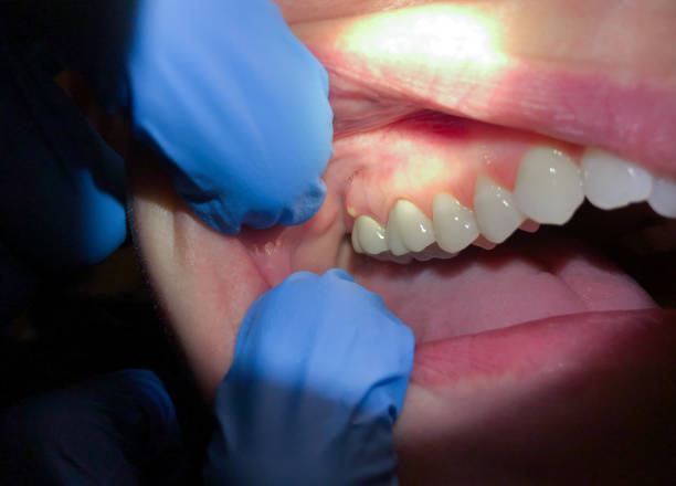 Best Emergency Root Canal Treatment in Jonesboro, IL
